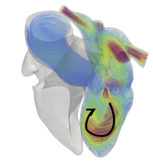 CFD Hemodynamic Simulation